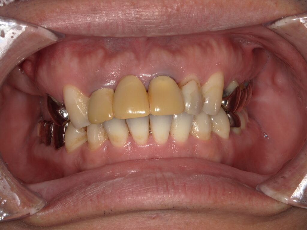 新福島中之島かとう歯科ブリッジ