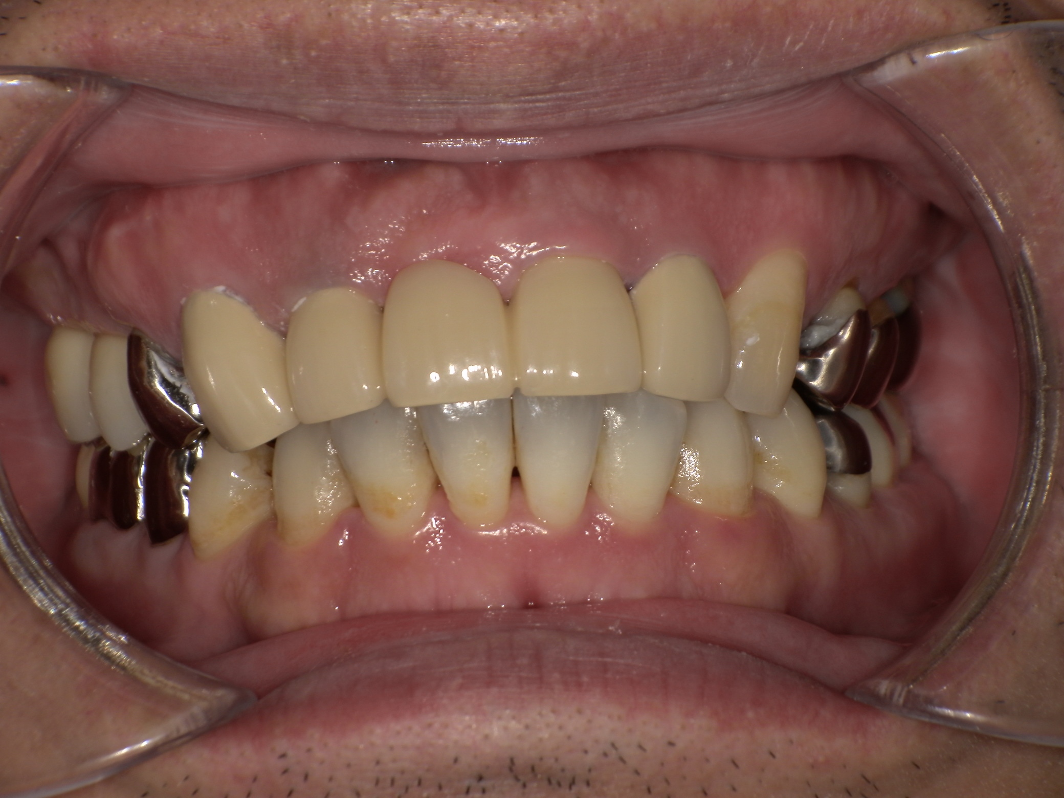 新福島中之島かとう歯科ブリッジ