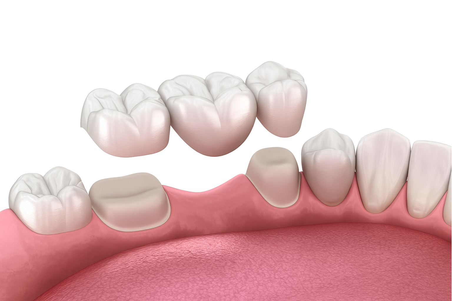 新福島中之島かとう歯科ブリッジ