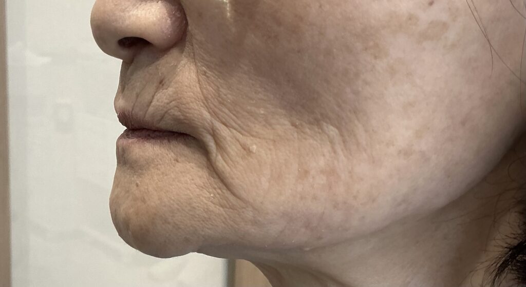 新福島中之島かとう歯科 入れ歯