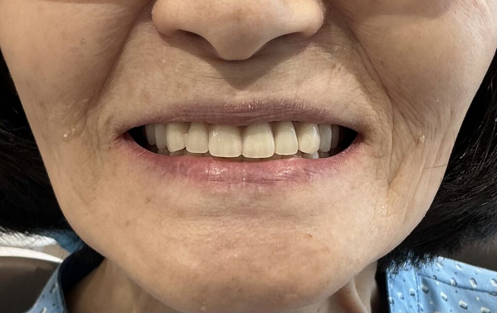 新福島中之島かとう歯科入れ歯