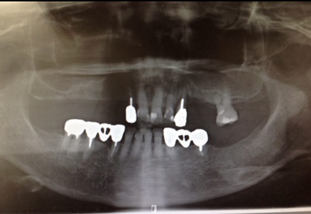 新福島中之島かとう歯科
サイナスリフト