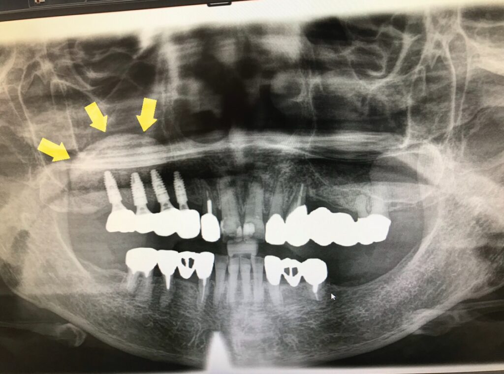 新福島中之島かとう歯科サイナスリフト