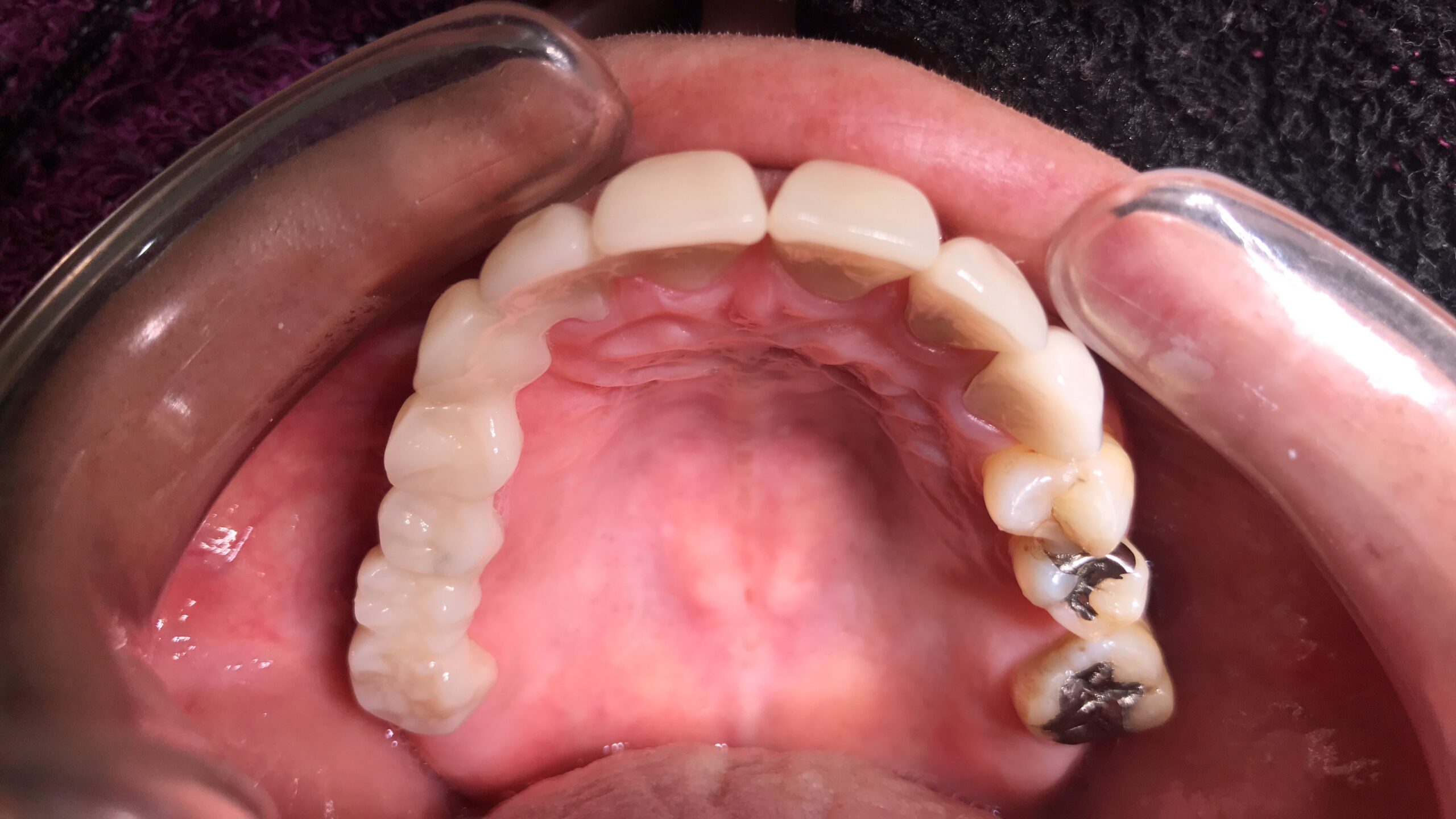 新福島中之島かとう歯科ブリッジ