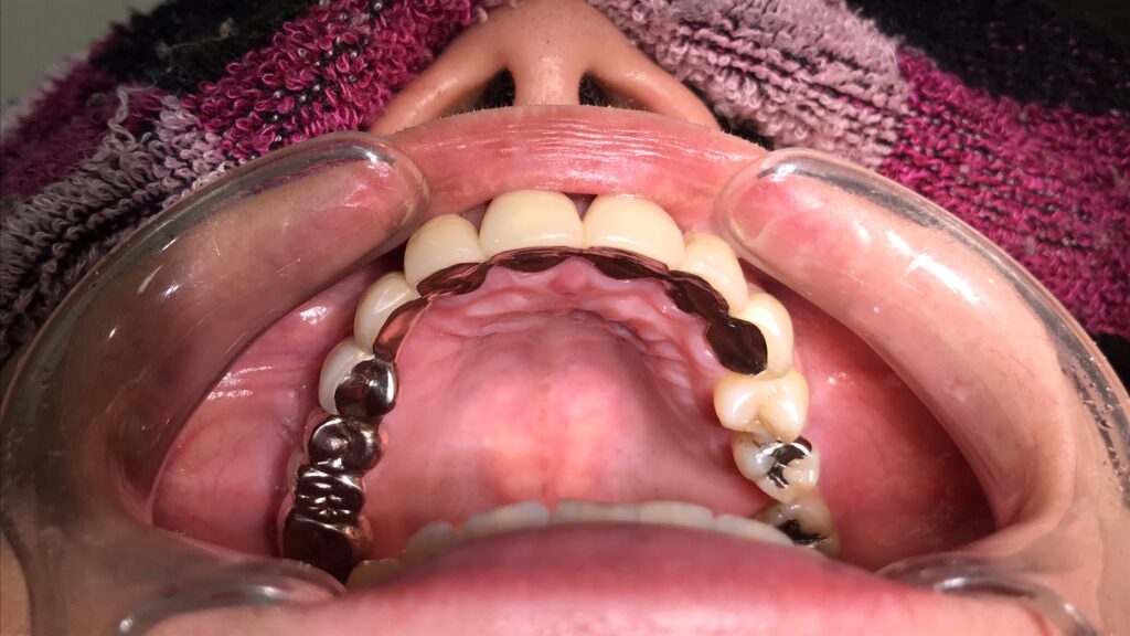 新福島中之島かとう歯科
ブリッジ