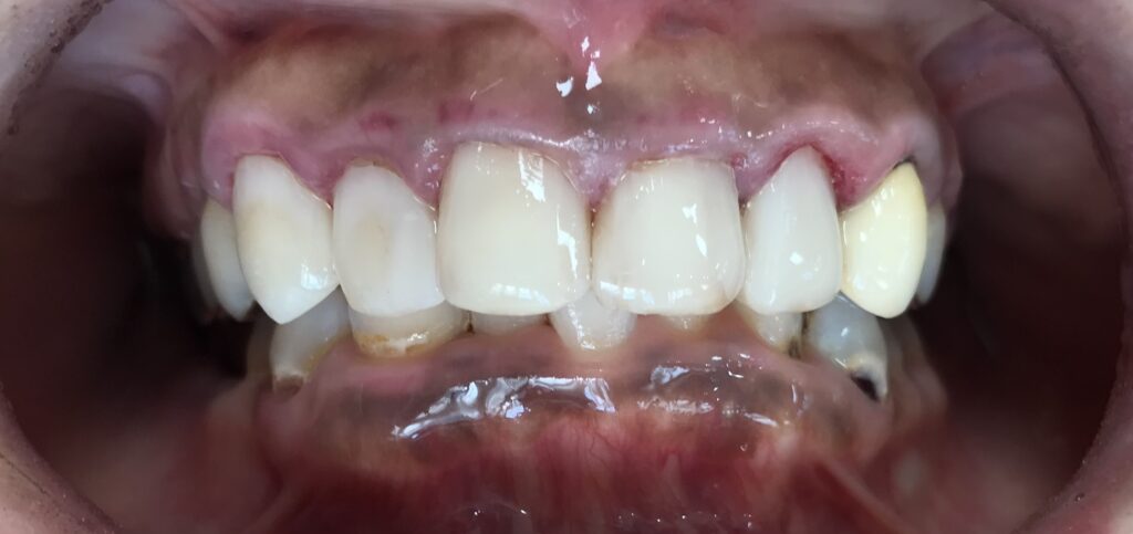 新福島中之島かとう歯科虫歯治療