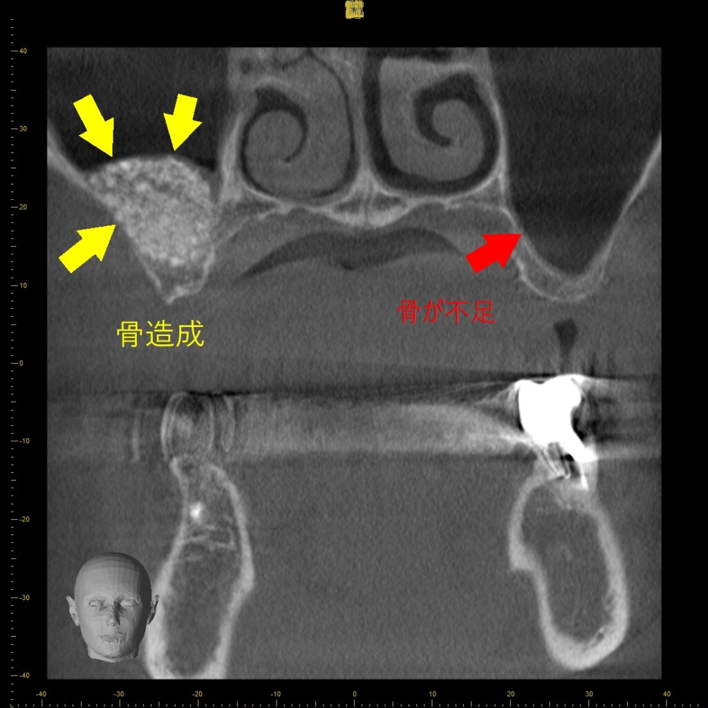 サイナスリフト